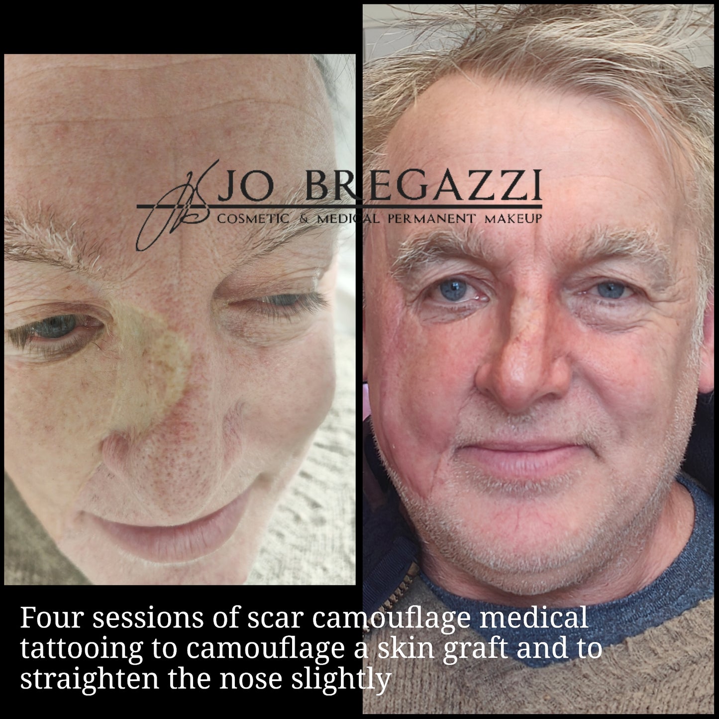 1 Day Advanced Masterclass in Scar Camouflage Techniques & Working on Damaged Skin