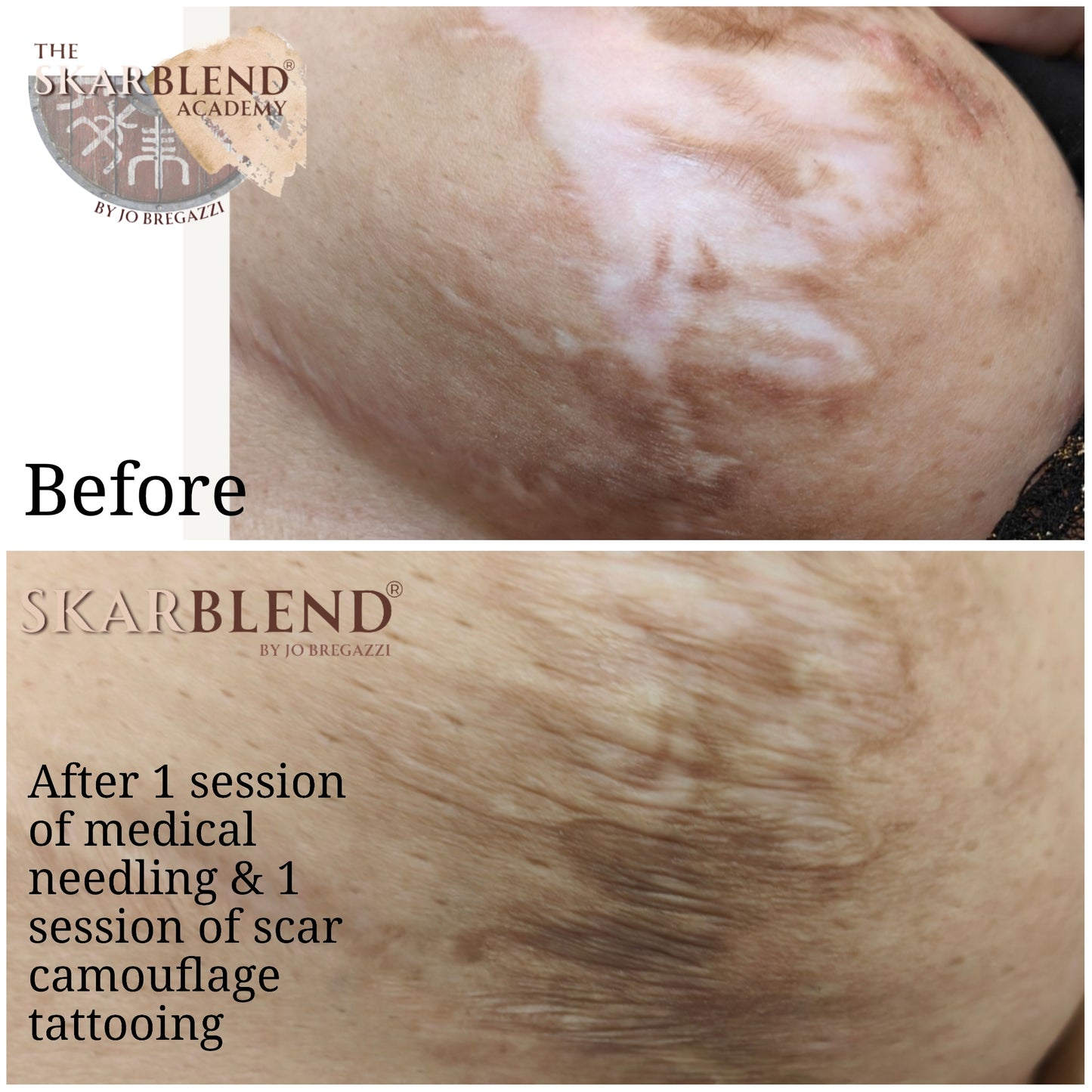 1 Day Advanced Masterclass in Scar Camouflage Techniques & Working on Damaged Skin