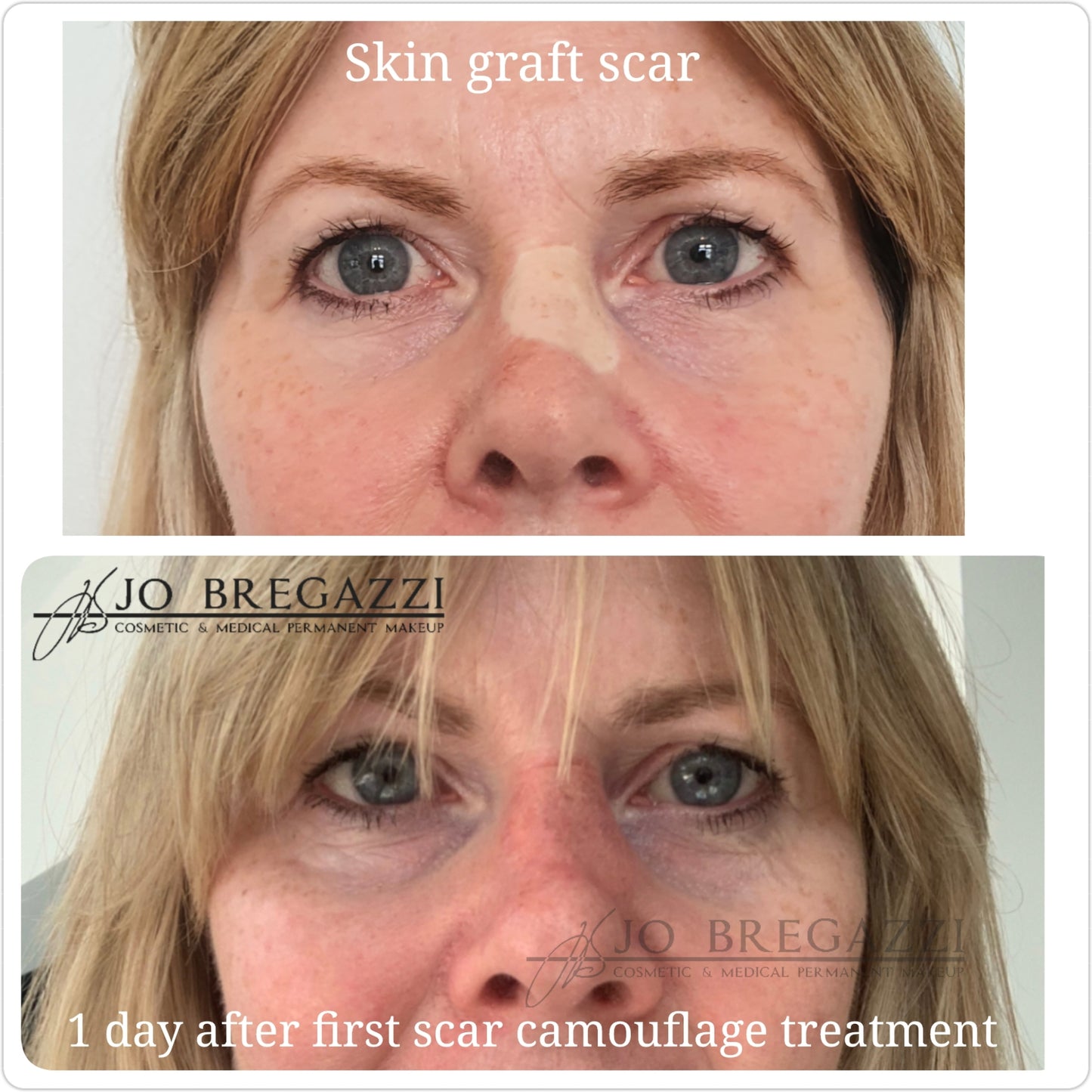1 Day Advanced Masterclass in Scar Camouflage Techniques & Working on Damaged Skin