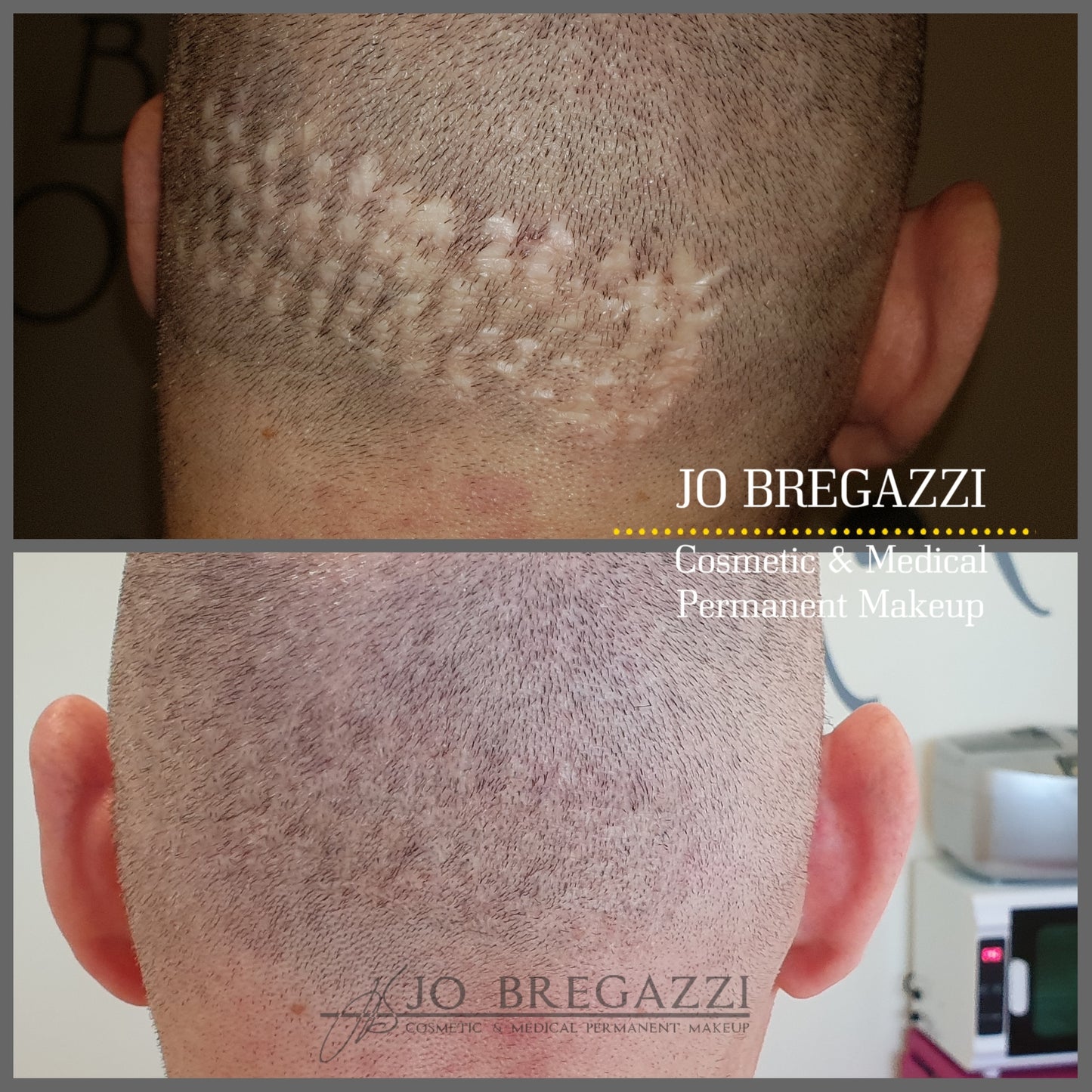 1 Day Advanced Masterclass in Scar Camouflage Techniques & Working on Damaged Skin