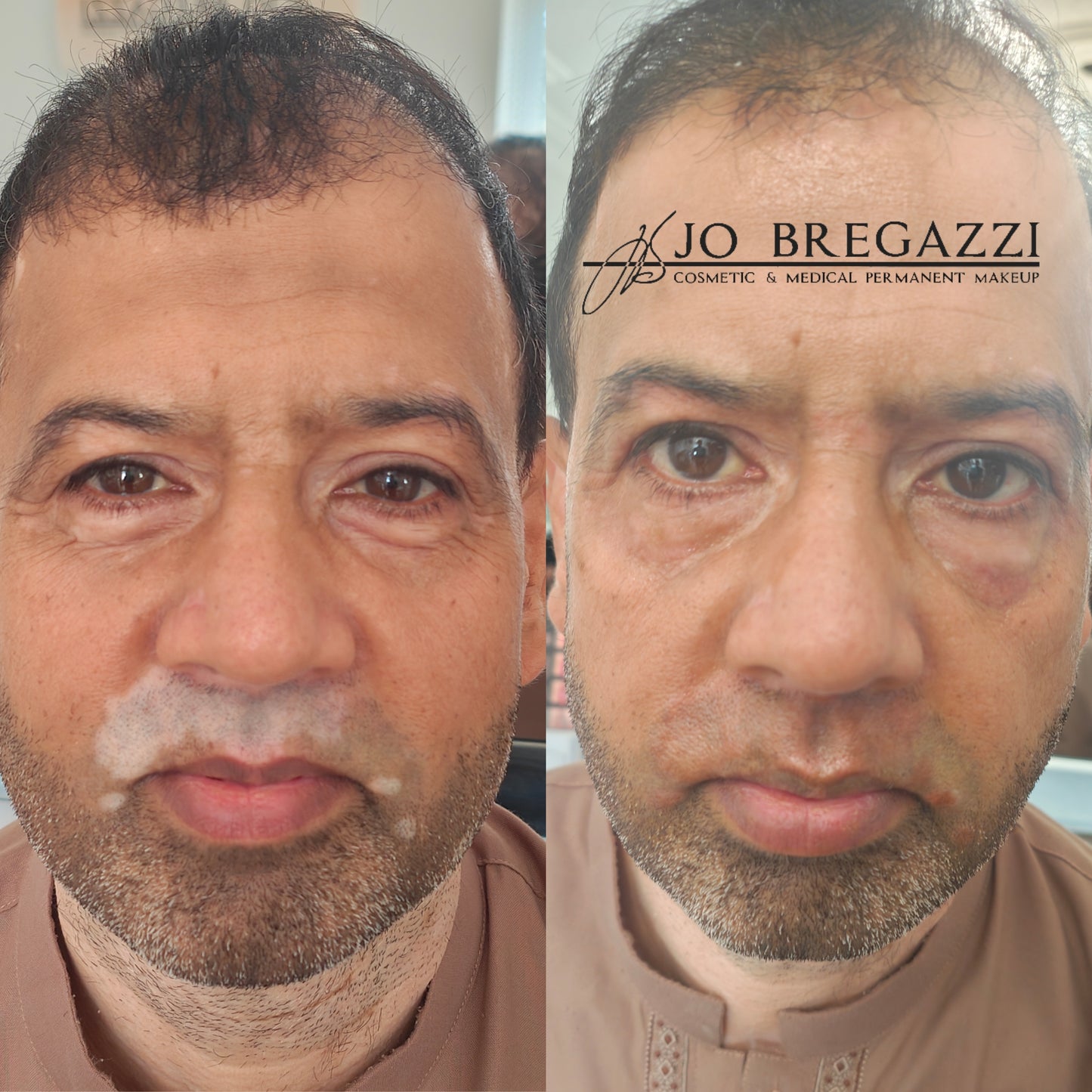 Skin, Scar and Stretchmark Treatments & Camouflage : Training & Mentorship For trained PMU Artists