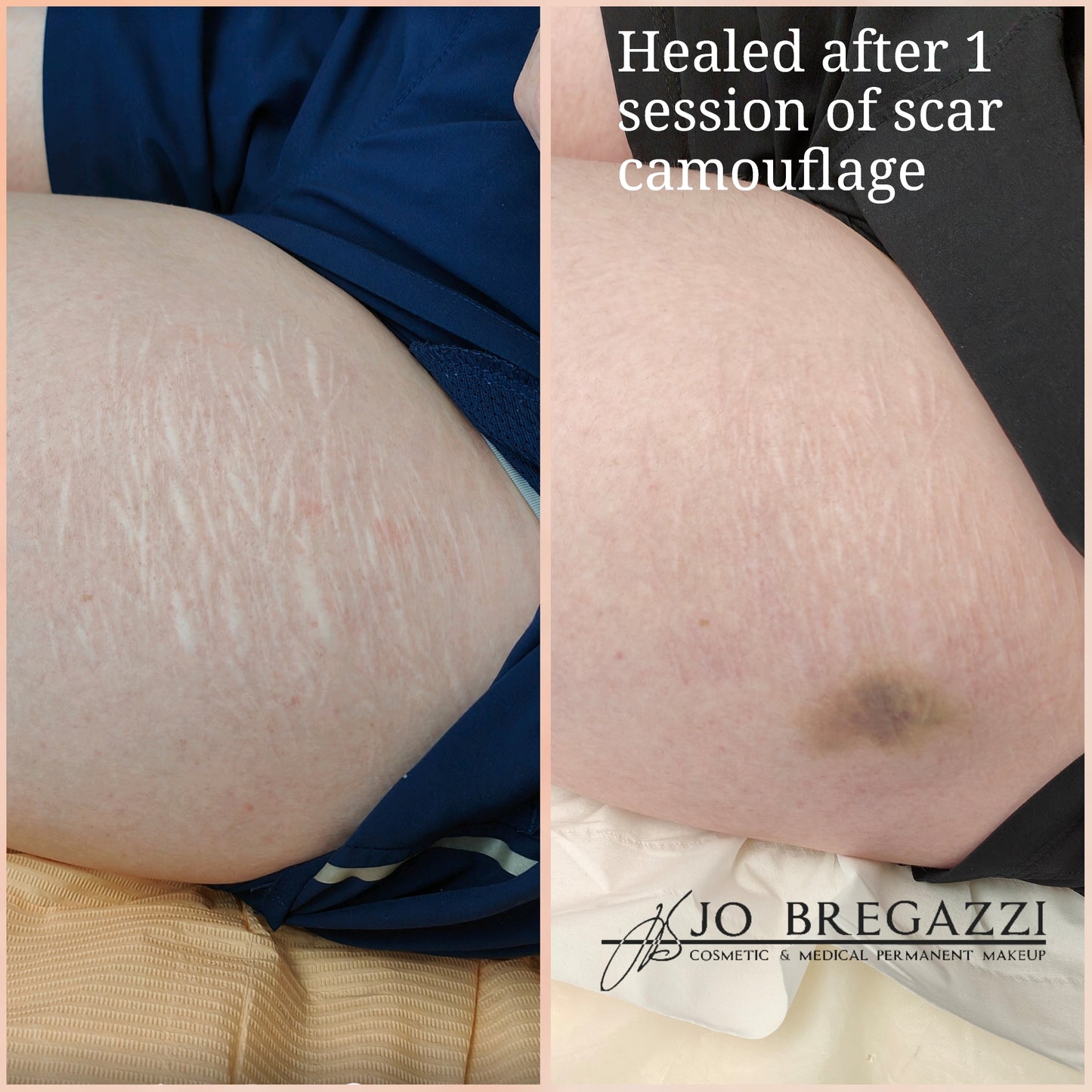 1 Day Advanced Masterclass in Scar Camouflage Techniques & Working on Damaged Skin