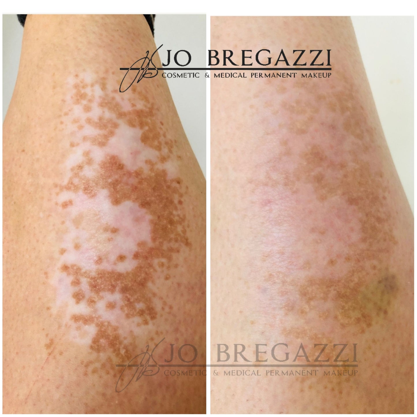 1 Day Advanced Masterclass in Scar Camouflage Techniques & Working on Damaged Skin