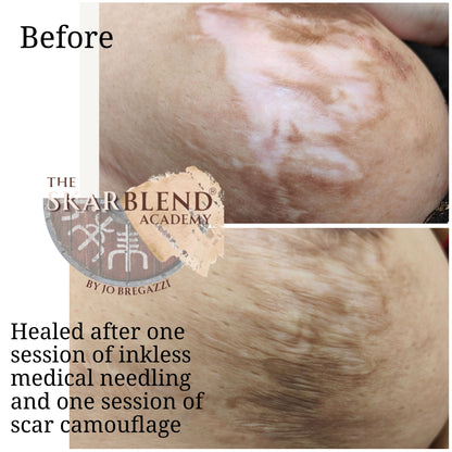 Skin, Scar and Stretchmark Camouflage : Training & Mentorship for Complete Beginners (In-person)